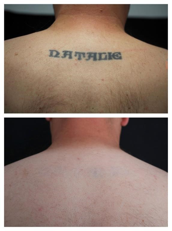 Tattoo Removal Myths Debunked | Apple Wellness Center
